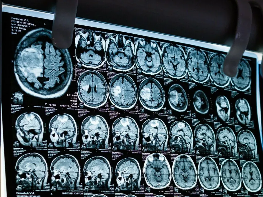 Zdjęcie rezonansu magnetycznego mózgu widoczne na ekranie diagnostycznym – ilustracja do sekcji ochrona zdrowia oraz startupy i nowe technologie medyczne w kancelarii KRK